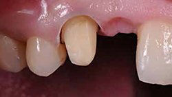 RONDOflex-plus-360_Bridge0_800px.jpg