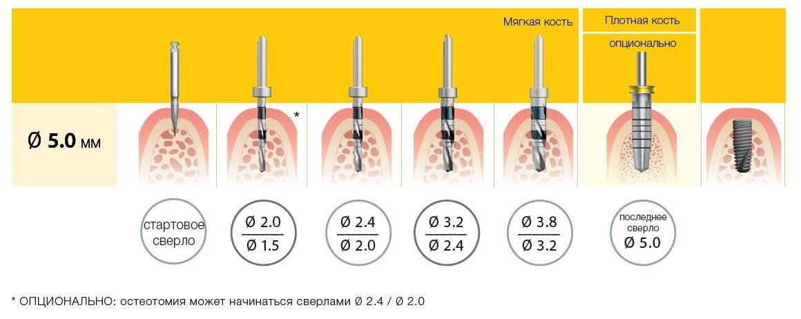 Рекомендуемый протокол установки имплантатов.jpeg